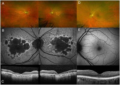 Age-related macular degeneration: suitability of optogenetic therapy for geographic atrophy